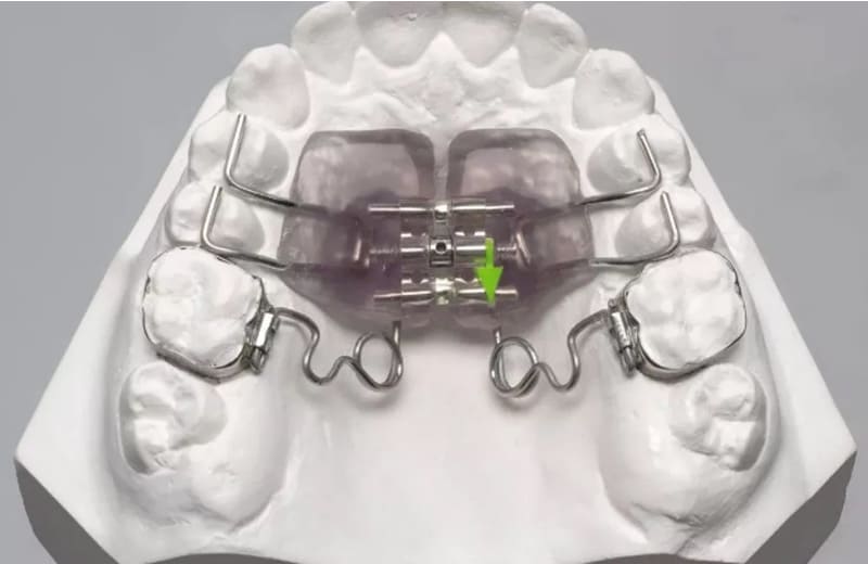 Çənə genişləndirici aparatlar