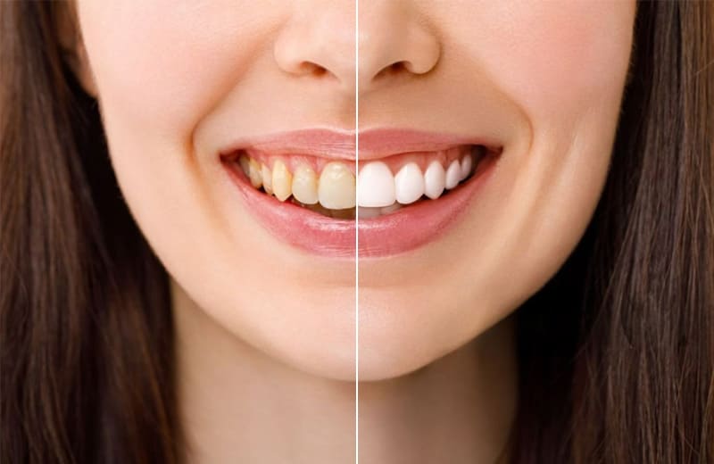 Dişlərin Ağardılması