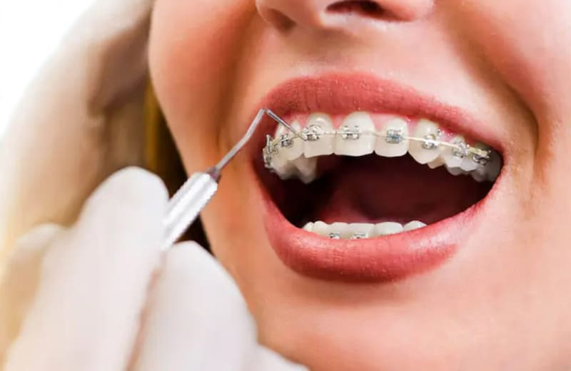 Breketlərlə müalicə