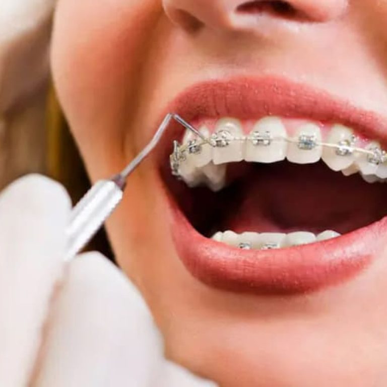 Breketlərlə müalicə