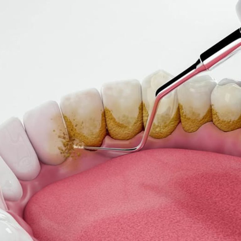 Diş daşlarının təmizlənməsi