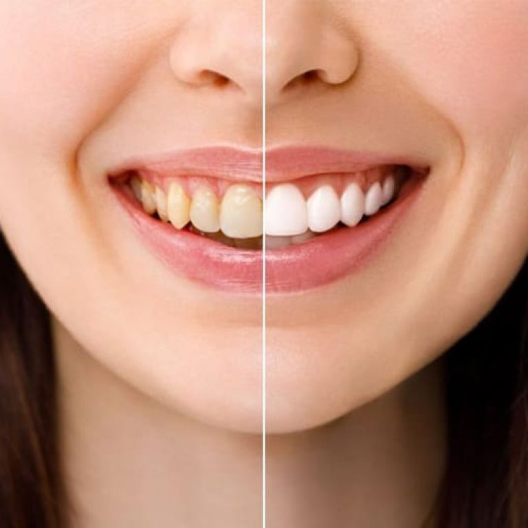 Dişlərin Ağardılması